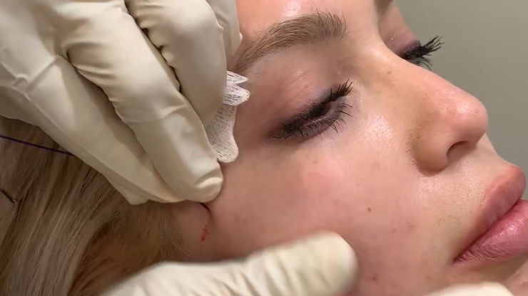 Threadlift